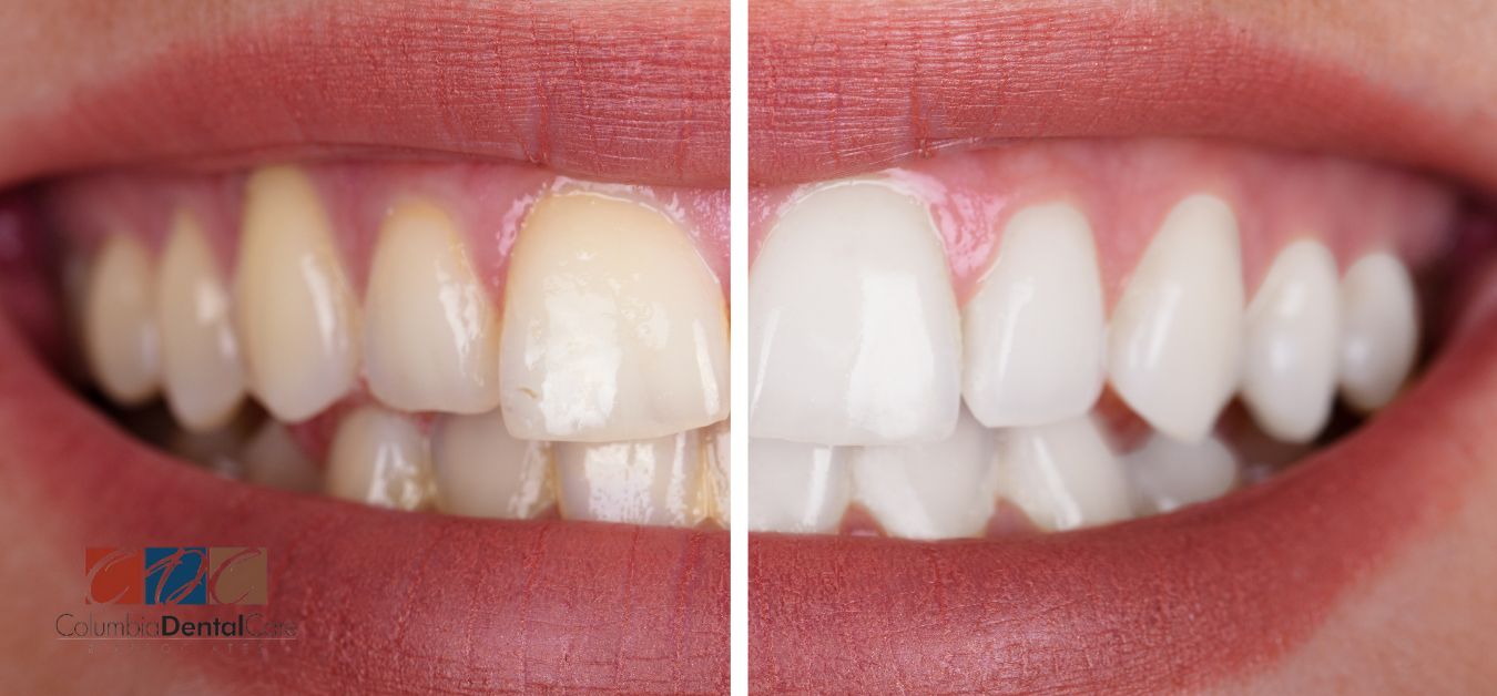 Columbia Dental teeth whitening dentist